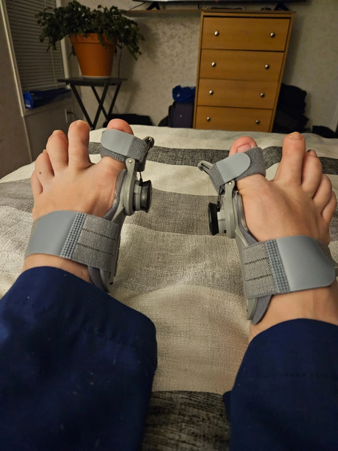 Foto de pies con corrector de juanetes