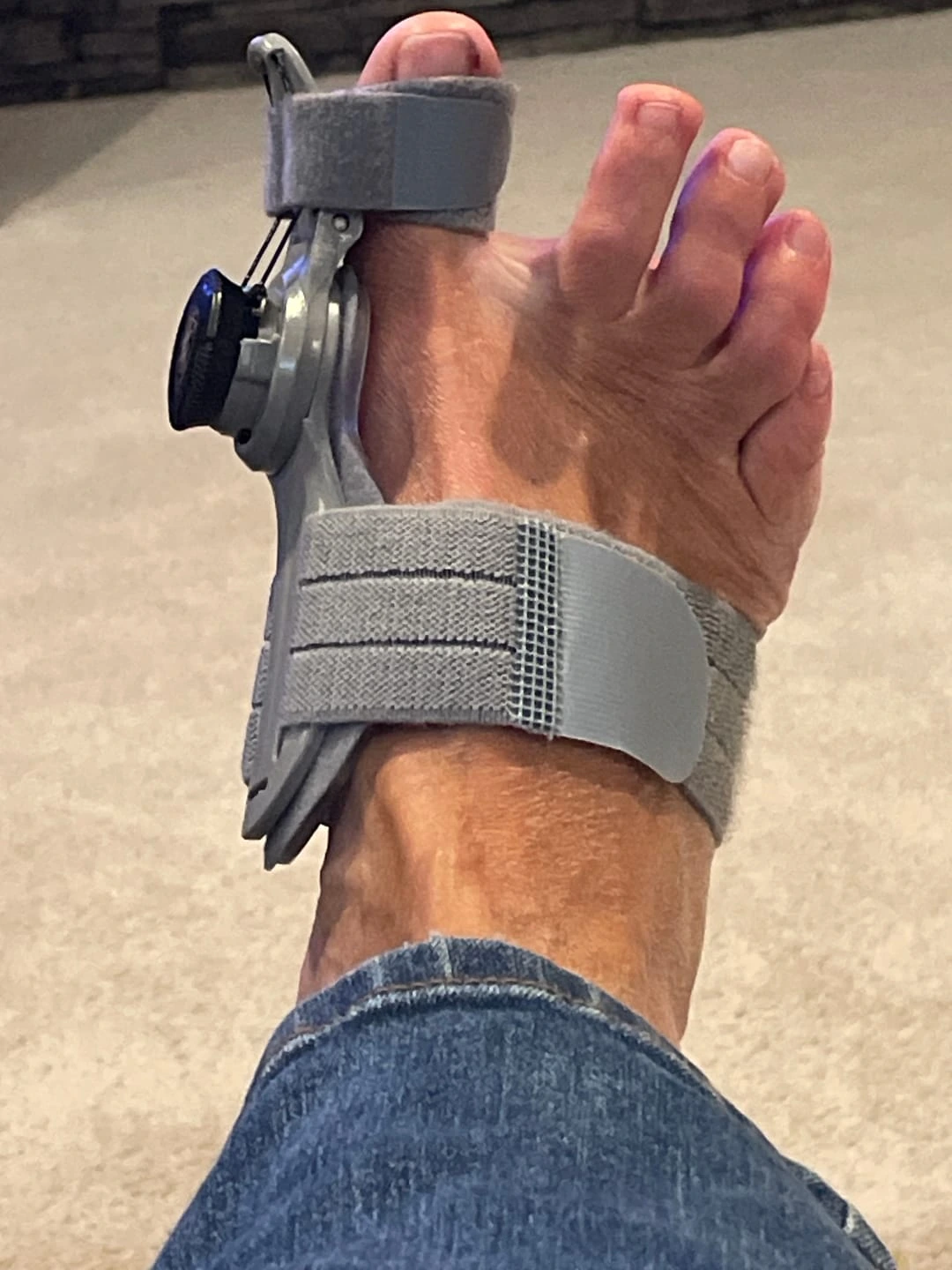 Foto de pies con corrector de juanetes