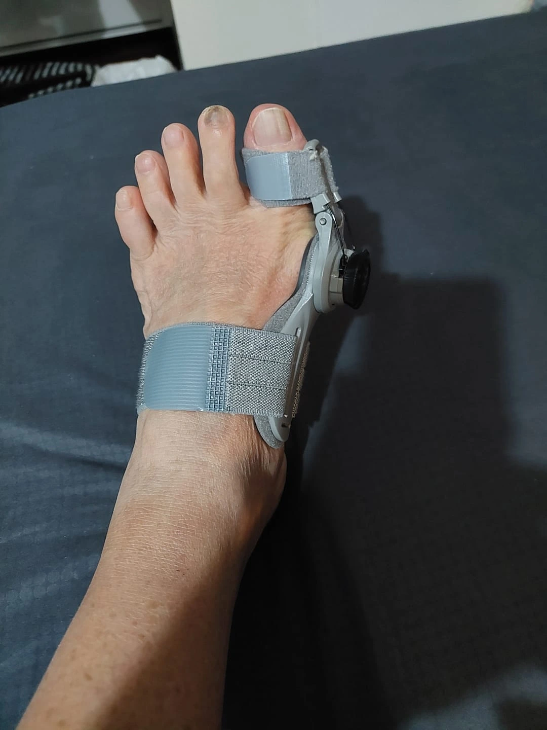 Foto de pies con corrector de juanetes