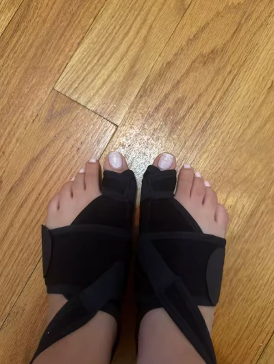 Foto de pies con corrector de juanetes