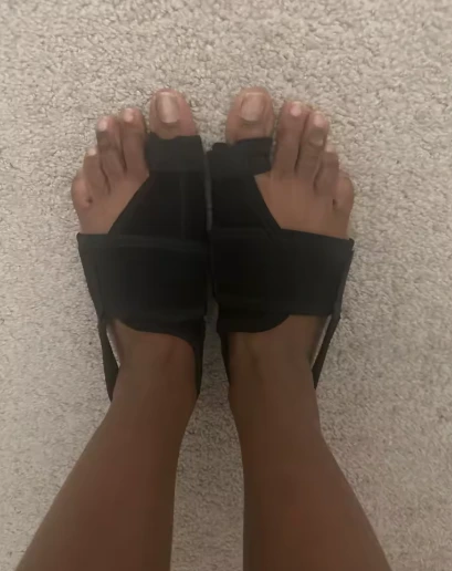 Foto de pies con corrector de juanetes